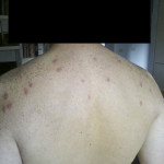 Lesioni strofuloidi multiple sulla schiena di un soggetto