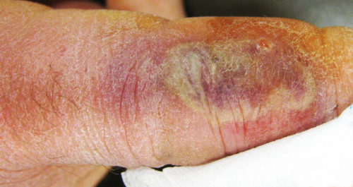 Morso di Loxosceles rufescens - lesione eritemato-flittenulare a contenuto siero-ematico, tipica della forma cutaneo-necrotica - foto Prof.Mario Principato